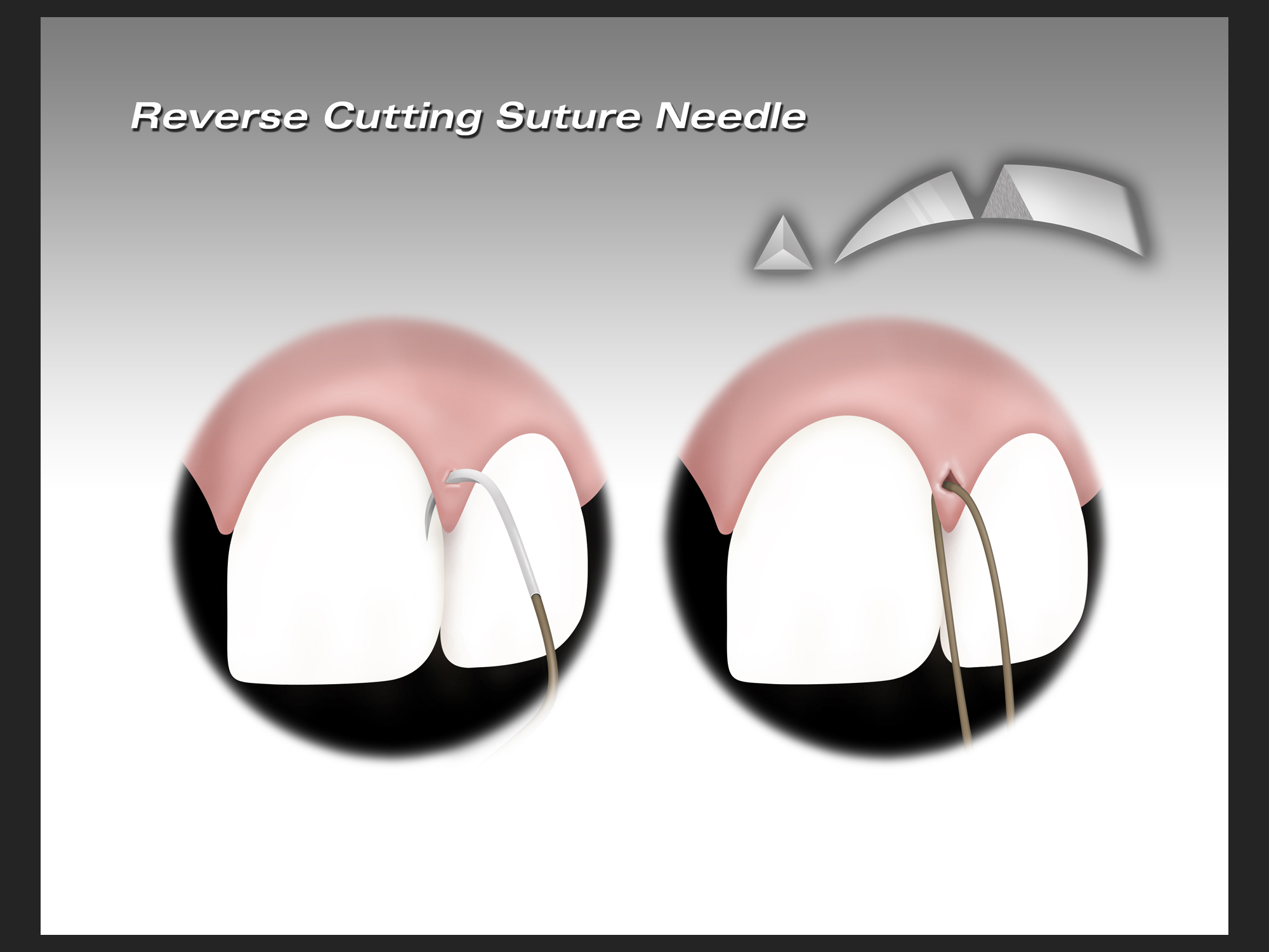 Reverse Cutting Suture Needle, Photoshop illustration for slide, 2013.