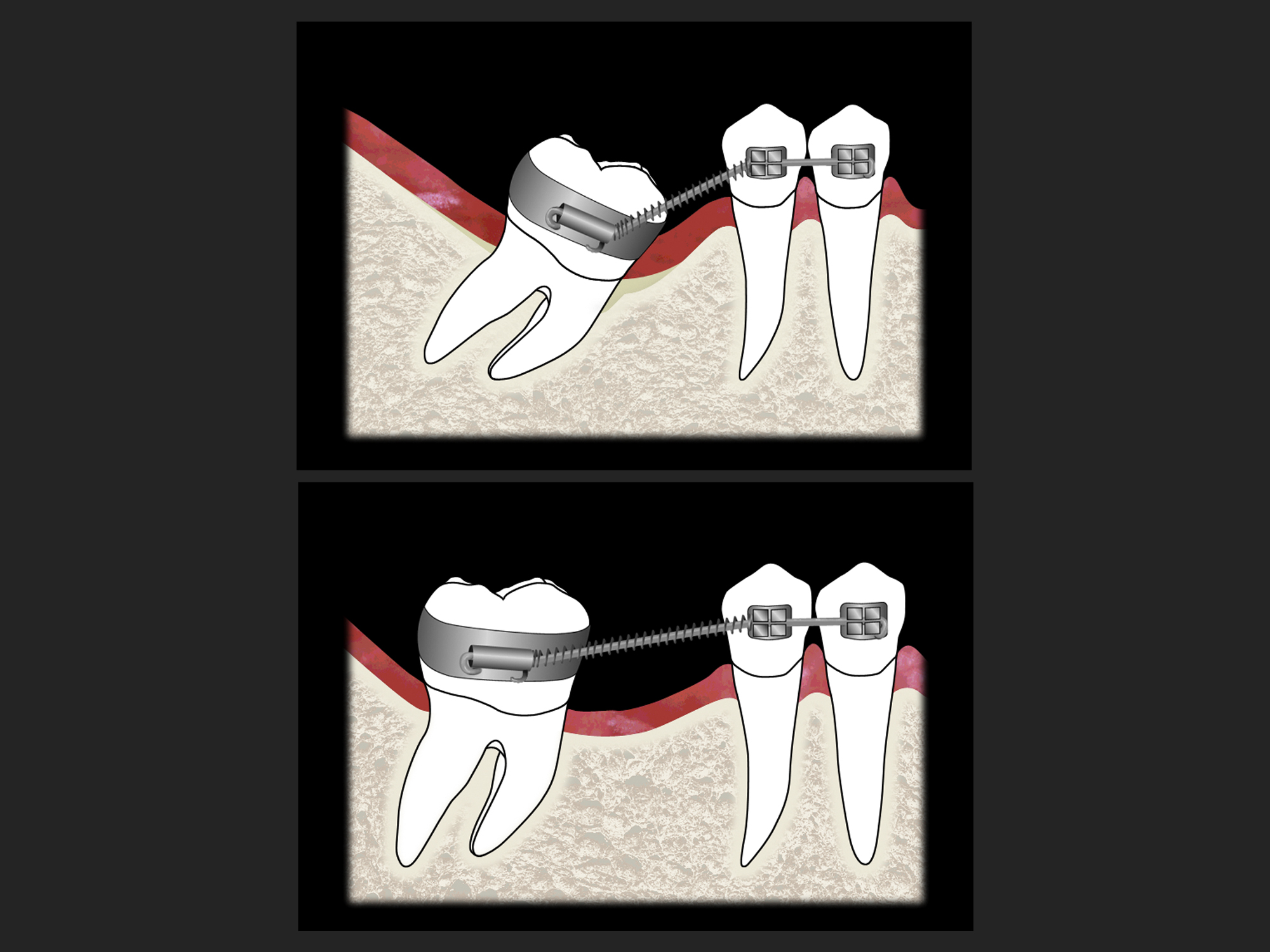 Uprighting a posterior molar: Photoshop slide illustration, 2005.